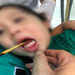 Chạy chơi bị ngã, bé 3 tuổi bị xiên que đâm xuyên qua lưỡi