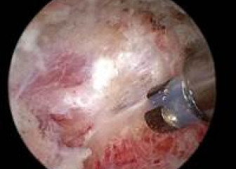 Phẫu thuật nội soi cột sống thắt lưng điều trị thoát vị đĩa đệm tại Bệnh viện A