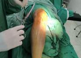 Phẫu thuật kết hợp xương trên màn hình tăng sáng tại Bệnh viện A - Phương pháp tối ưu trong điều trị gãy xương