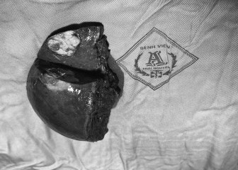 Bệnh viện A phẫu thuật thành công khối u gan cho bệnh nhân nam 37 tuổi